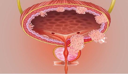 ASCO — 2025: тихая эпидемия, или Как мы будем бороться против рака мочевого пузыря в ближайшие десятилетия