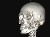 Как устраняют дефекты черепа, лица и челюстей