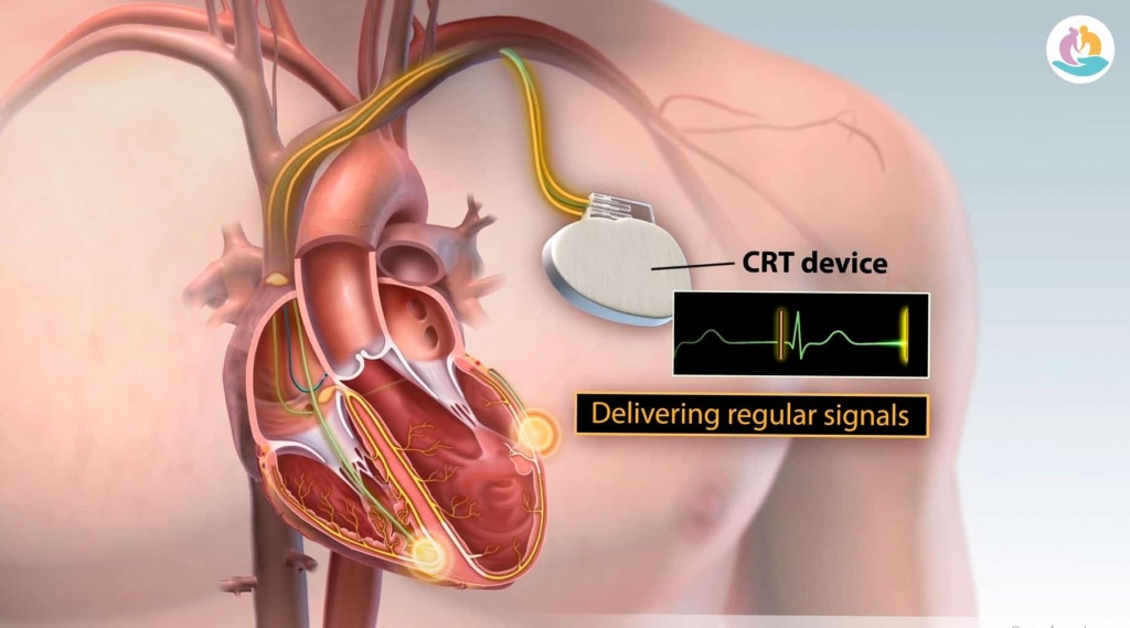 Девайсы для лечения сердечной недостаточности