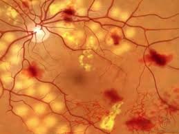 Диабетическая ретинопатия: диалог эндокринолога и офтальмолога