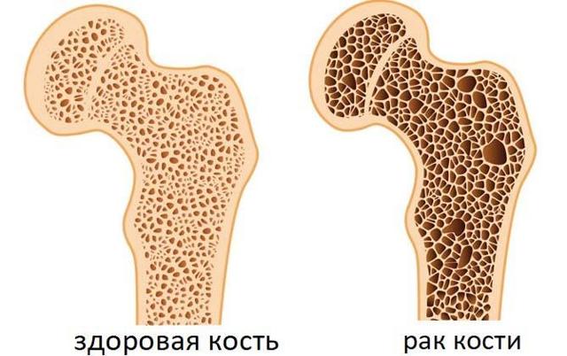 Злокачественные опухоли костей