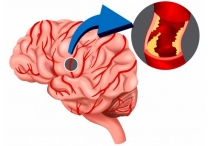 Ишемический инсульт уносит от 5 до 6 млн человек в год