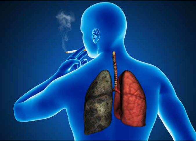 Курение как фактор риска развития онкологических заболеваний