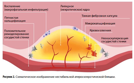 Атеросклероз сосудов: что может ВСУЗИ?