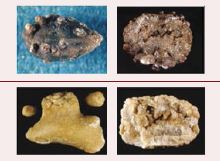 Классификации мочевых камней — взгляд эндоуролога
