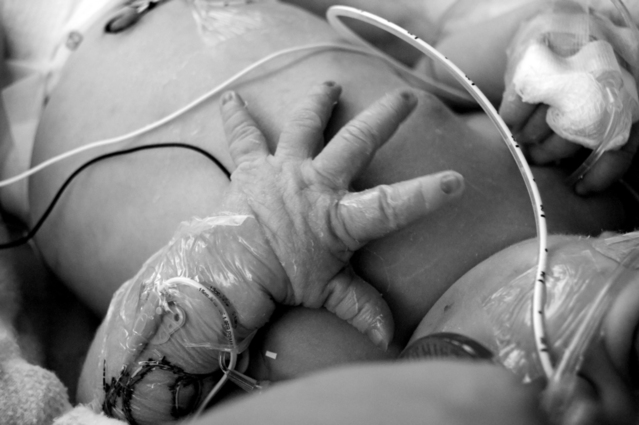 Обязательный скрининг новорожденных на критические пороки сердца спасает жизни