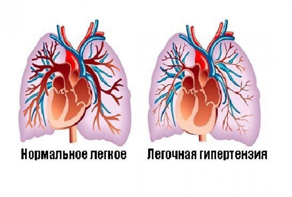 Бозентан — «золотой стандарт» в лечении легочной артериальной гипертензии