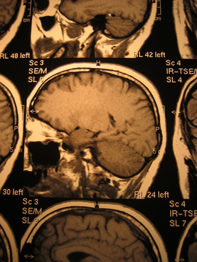 МРТ оценит неврологические расстройства после остановки сердца