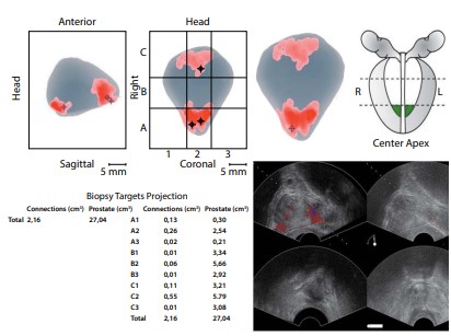 Нюансы биопсии простаты: таргетная технология гистофьюжн