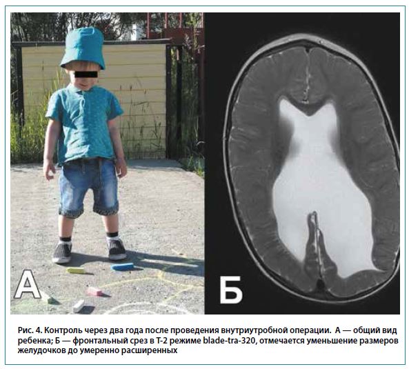 Рис. 4. Контроль через два года после проведения внутриутробной операции. А — общий видребенка; Б — фронтальный срез в Т-2 режиме blade-tra-320, отмечается уменьшение размеровжелудочков до умеренно расширенных