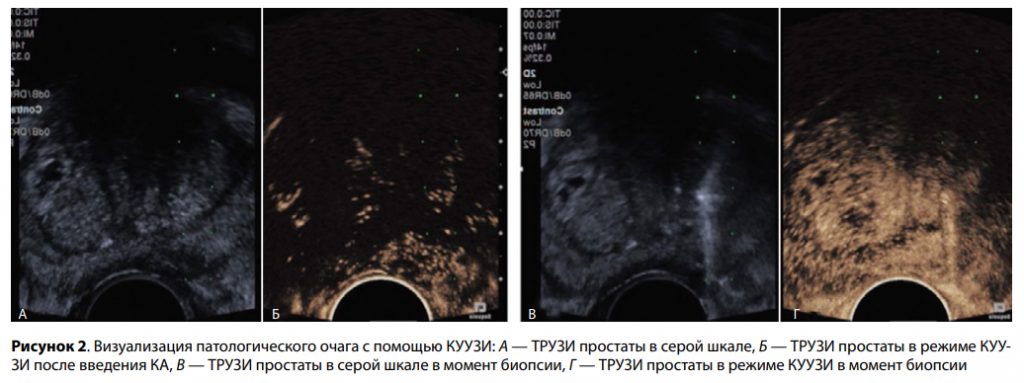 Опыт применения УЗИ с контрастом в прицельной биопсии простаты