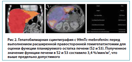 Рис 2. Гепатобилиарная сцинтиграфия с 99mTc-mebrofenin: передвыполнением расширенной правосторонней гемигепатэктомии дляоценки функции планируемого остатка печени (S2 и S3). Полученноезначение функции печени в S2 и S3 составило 3,4 %/мин/м2, чтовыше предельно допустимого