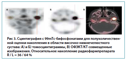 Рис 3. Сцинтиграфия с 99mTс-бифосфонатами для полуколичествен-ной оценки накопления в области височно-нижнечелюстногосустава: А) и Б) томосцинтиграммы, В) ОФЭКТ/КТ совмещенныеизображения. Относительное накопление радиофармпрепаратаR / L = 36 / 64 %