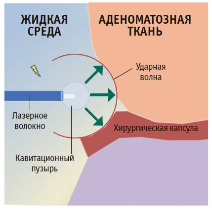 Рис. 3. Механизм кавитационного эффекта при лазерной энуклеацииаденоматозной ткани предстательной железы