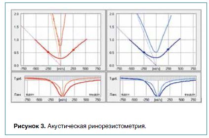 Рисунок 3. Акустическая ринорезистометрия.