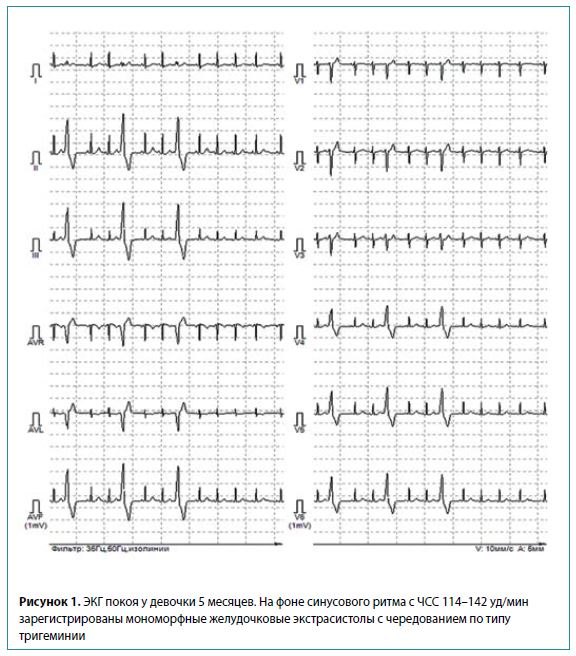 Рисунок 1. ЭКГ покоя у девочки 5 месяцев. На фоне синусового ритма с ЧСС 114-142 уд/мин зарегистрированы мономорфные желудочковые экстрасистолы с чередованием по типу тригеминии
