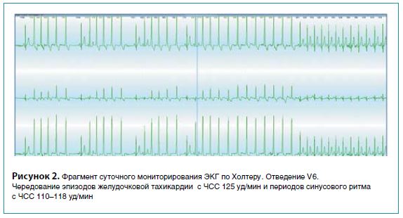 Рисунок 2. Фрагмент суточного мониторирования ЭКГ по Холтеру. Отведение V6.Чередование эпизодов желудочковой тахикардии с ЧСС 125 уд/мин и периодов синусового ритма с ЧСС 110-118 уд/мин