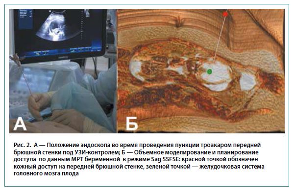 Рис. 2. А — Положение эндоскопа во время проведения пункции троакаром переднейбрюшной стенки под УЗИ-контролем; Б — Объемное моделирование и планированиедоступа по данным МРТ беременной в режиме Sag SSFSE: красной точкой обозначенкожный доступ на передней брюшной стенке, зеленой точкой — желудочковая системаголовного мозга плода