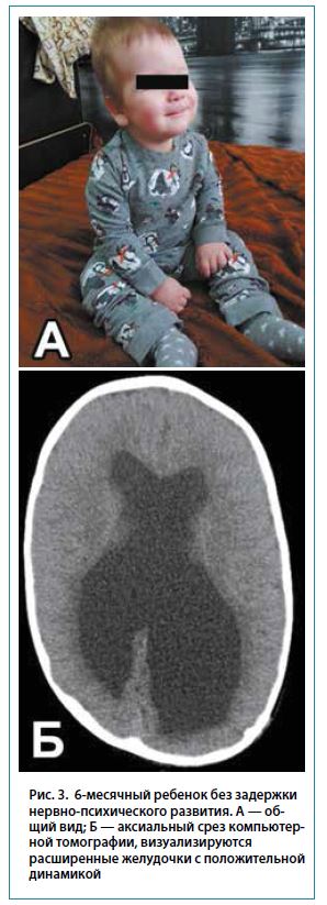 Рис. 3. 6-месячный ребенок без задержкинервно-психического развития. А — об-щий вид; Б — аксиальный срез компьютер-ной томографии, визуализируютсярасширенные желудочки с положительнойдинамикой