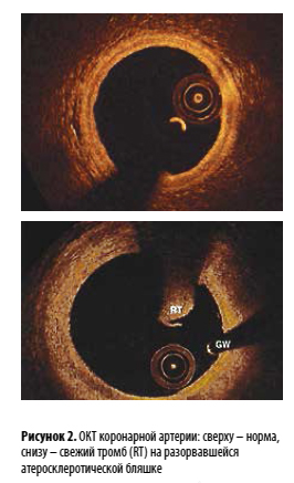 Рисунок 2. ОКТ коронарной артерии: сверху – норма,снизу – свежий тромб (RT) на разорвавшейсяатеросклеротической бляшке