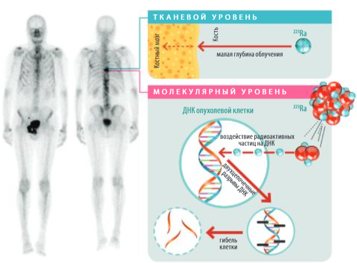 Схема действия радия-223 на метастазы в костях
