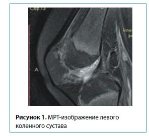 Рисунок 1. МРТ-изображение левогоколенного сустава