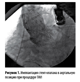 Рисунок 1. Имплантация стент-клапана в аортальнуюпозицию при процедуре TAVI