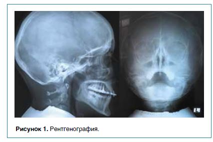 Рисунок 1. Рентгенография.