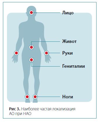 Рис 3. Наиболее частая локализацияАО при НАО