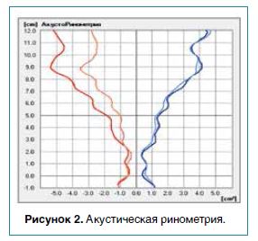 Рисунок 2. Акустическая ринометрия.