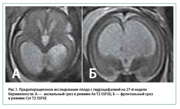 Рис.1. Предоперационное исследование плода с гидроцефалией на 27-й неделебеременности. А — аксиальный срез в режиме Ax T2 SSFSE; Б — фронтальный срезв режиме Cor T2 SSFSE
