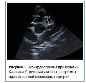 Рисунок 1. Эхокардиограмма при болезниКавасаки. Стрелками указаны аневризмыправой и левой коронарных артерий